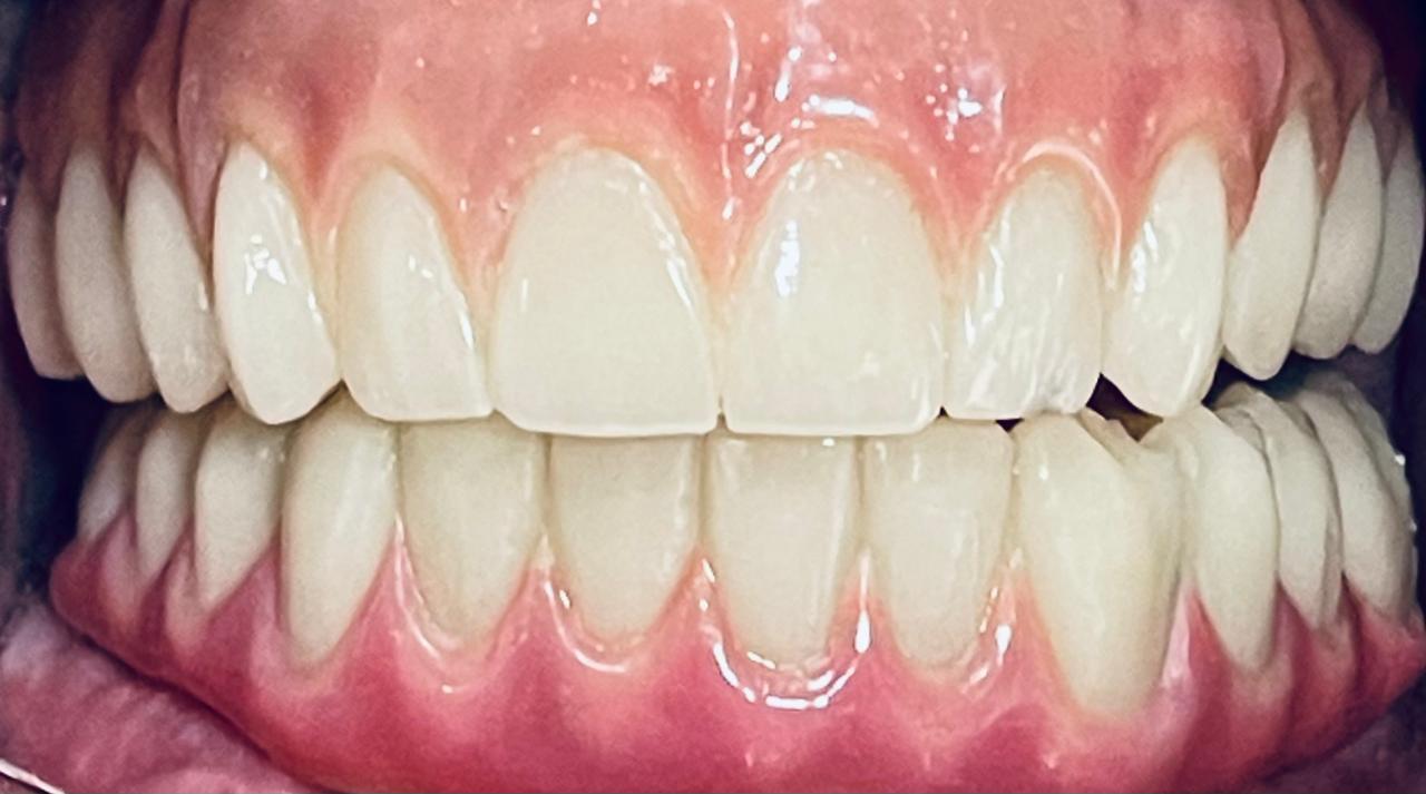 Implantes